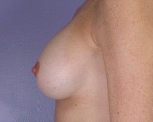 Breast Augmentation